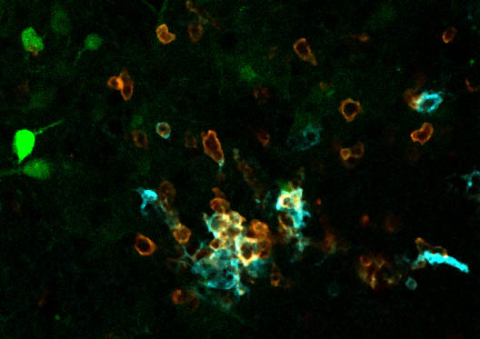 Herpeszvírussal fertőzött (zöld) és degenerálódott (kék) idegsejtekhez toborzódó gyulladásos sejtek (narancs) az agyban  (FEKETE REBEKA FELVÉTELE)