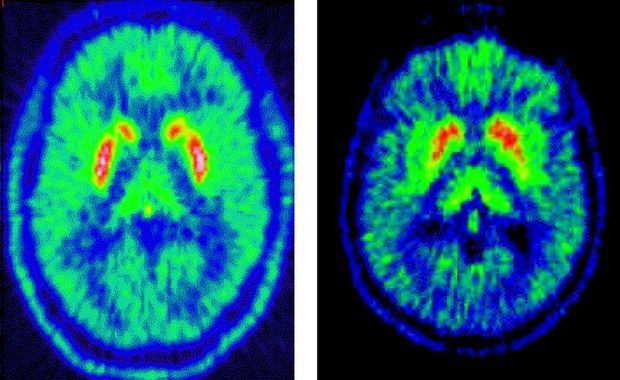 Parkinson-kóros beteg agyáról készített PET-felvétel (jobb) egy egészséges személy agyával (bal oldal) összehasonlítvaParkinson-kóros beteg agyáról készített PET-felvétel (jobb) egy egészséges személy agyával (bal oldal) összehasonlítva