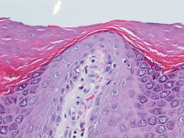 Pikkelysömörös hámszövet mikroszkópos felvétele